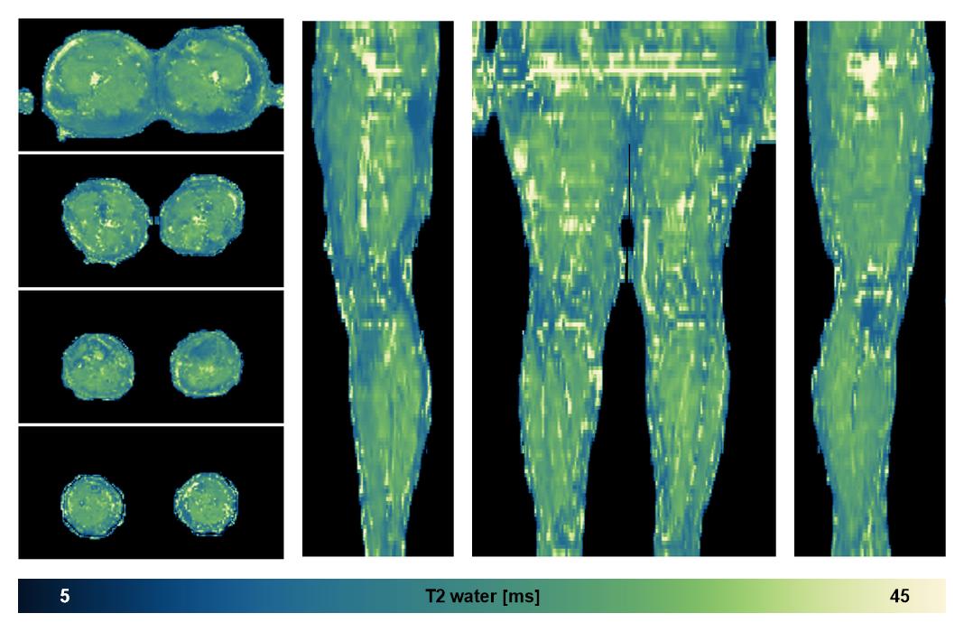 The water only T2 relaxation time of the lower extremity obtained from multi echo spin echo t2 mapping with EPG based reconstruction.